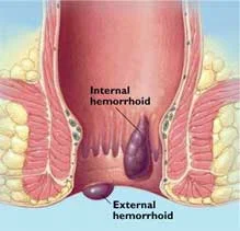 Unani medicine can treat piles