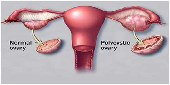 PCOS Treatment in Ayurveda