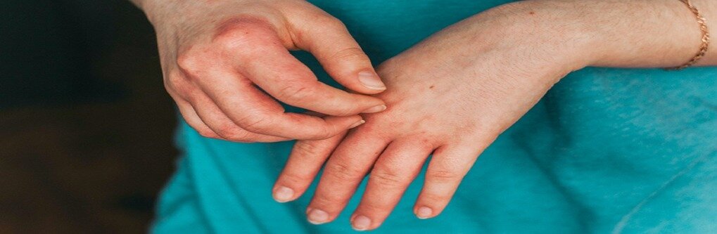 Ayurvedic Tips to Manage Skin/eczema System