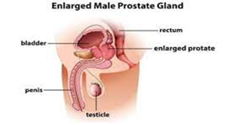 Enlarged Prostate Gland